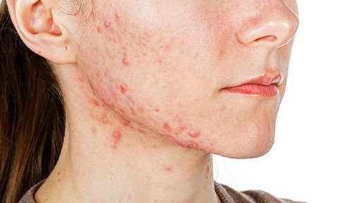 Traitement de l'acné