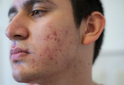 Traitement de l'acné