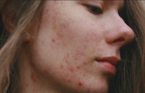 Traitement de l'acné